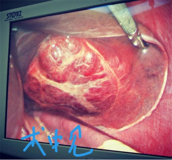 3.26腹腔镜左肝外侧叶切除微创手术 在新余第四医院获得成功192.jpg
